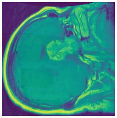 Pituitary